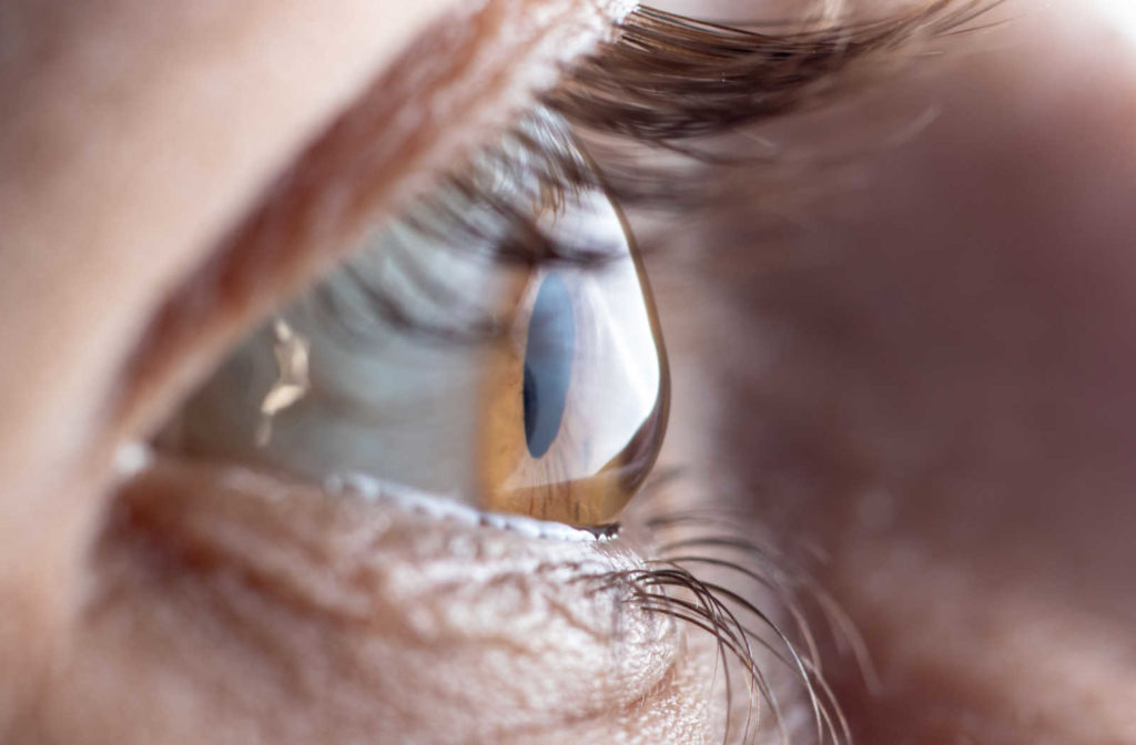 A close up of an eye with astigmatism showing how the cornea is irregularly shaped