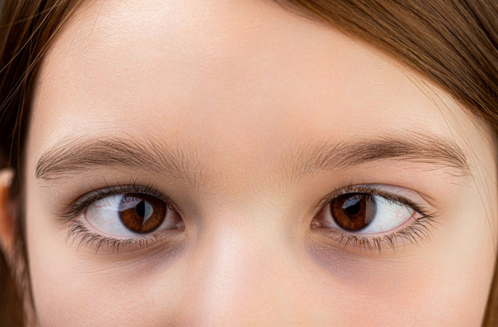 A close-up of a young girl with misaligned eyes